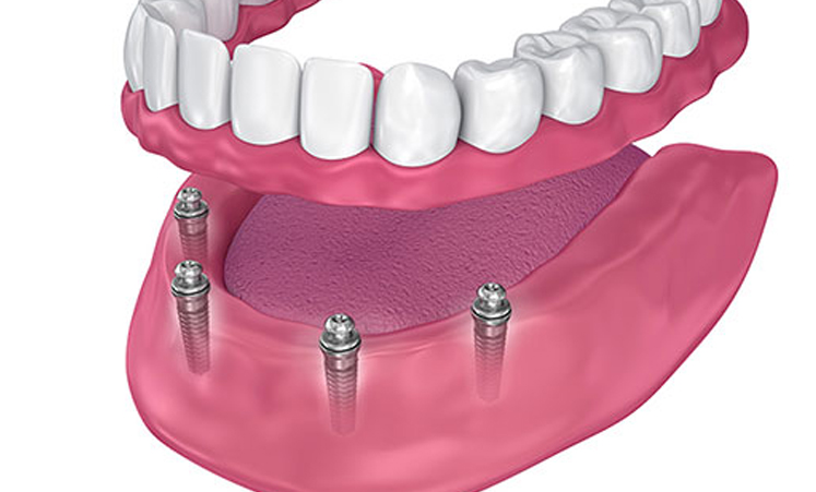 All on four six eight - Tooth Replacement in Stuart Florida
