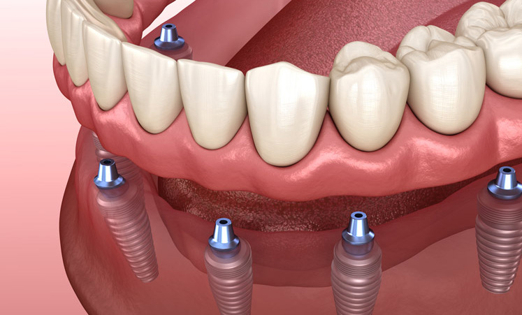 Removable dentures - Tooth Replacement in Stuart Florida