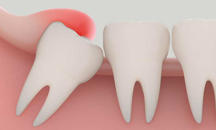 Wisdom tooth extraction - Oral Surgery in Stuart Florida