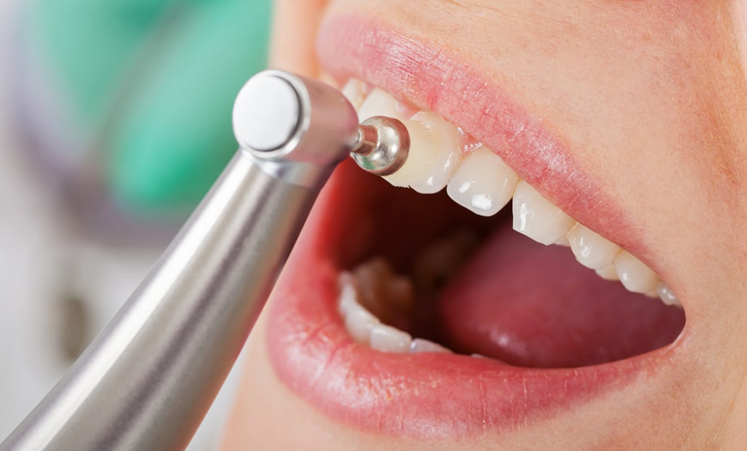 Teeth Cleaning - Preventative Dentistry