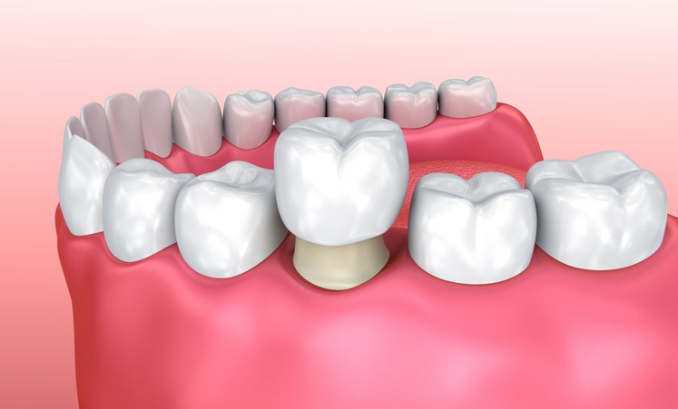 Dental crown - Restorative in Stuart Florida