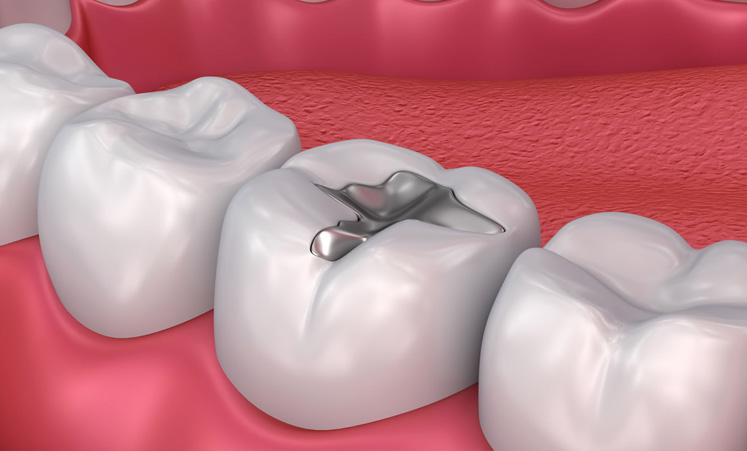 Fillings - Preventative Dentistry in Stuart Florida