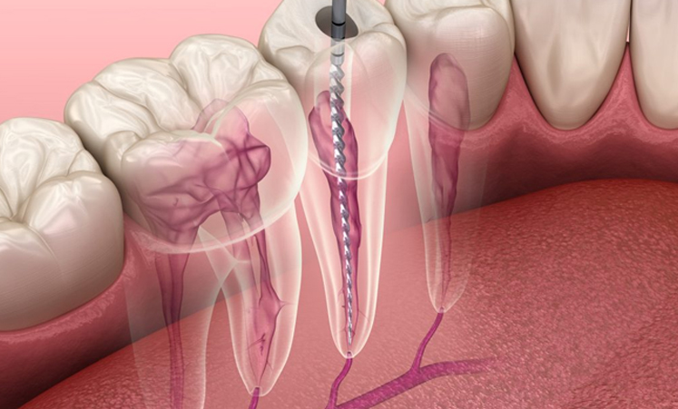 Treatments - Root canal
