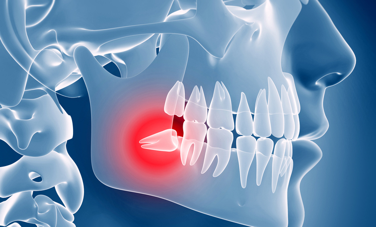 Wisdom tooth pain - Emergency Dentistry in Stuart Florida