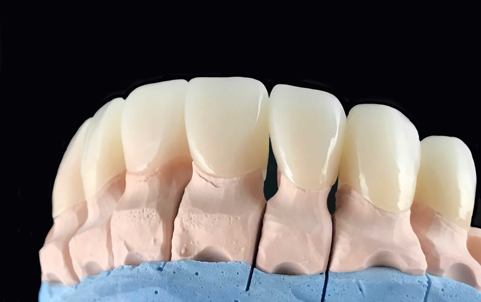 Broken Dental Crowns