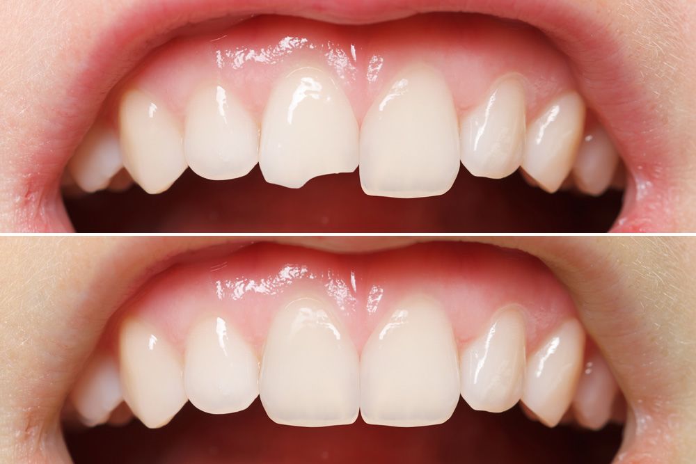 Teeth Bonding in Stuart FL – Fast Cosmetic Tooth Repair