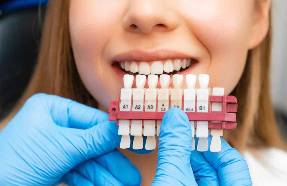 Transform Your Smile with Porcelain Veneers in Stuart, FL