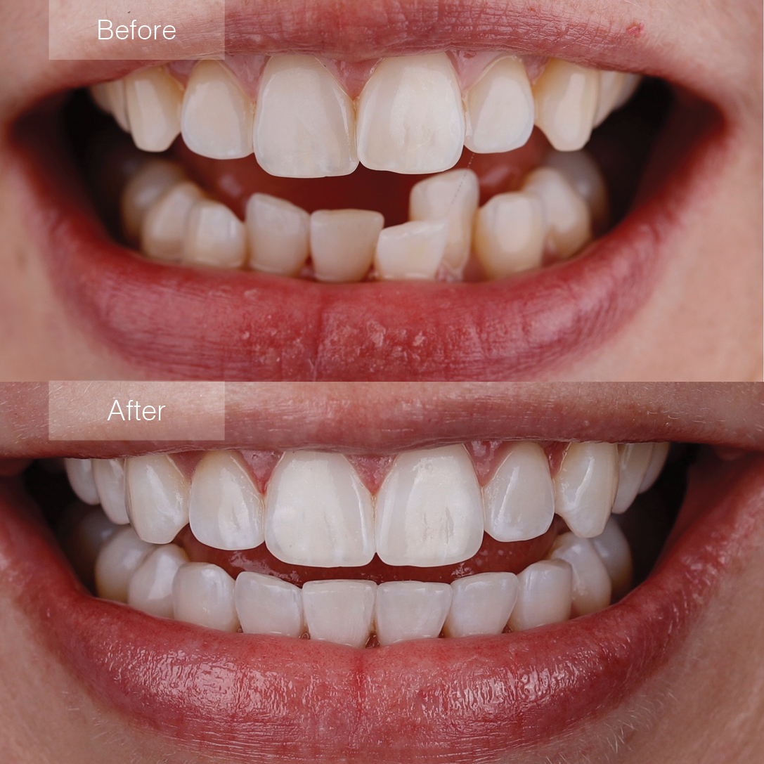 Invisalign treatment at McClane Dentistry