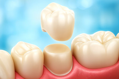 Restore Your Smile with Dental Implant Restoration in Stuart FL
