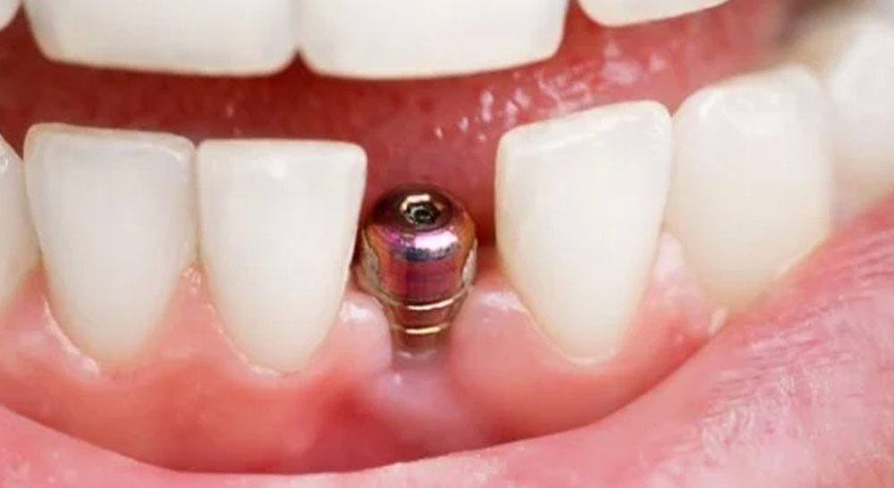 Replace a Missing Tooth with a Single Tooth Implant in Stuart