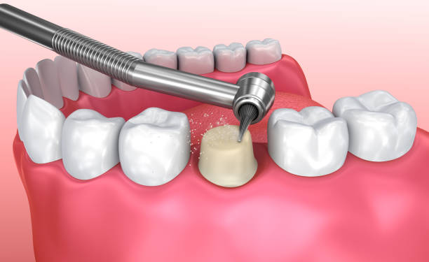 Toothache Emergency Dentistry at McClane Dentistry in Stuart, FL