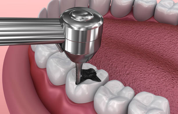 Removing the caries . Medically accurate tooth 3D illustration Toothache Emergency Dentistry at McClane Dentistry in Stuart, FL
