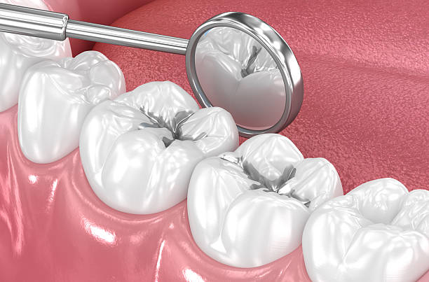 Amalgam tooth restoration. Dental 3D illustration Toothache Emergency Dentistry at McClane Dentistry in Stuart, FL
